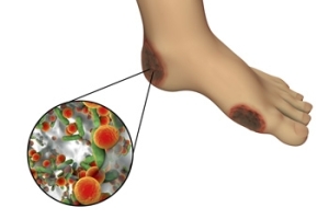 Causes of Athlete’s Foot