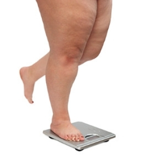 The Connection Between Obesity, RA, and the Health of Your Feet
