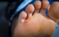 Protecting Your Feet from Plantar Warts at the Gym
