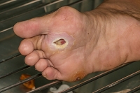 Why Do Foot Ulcers Develop?