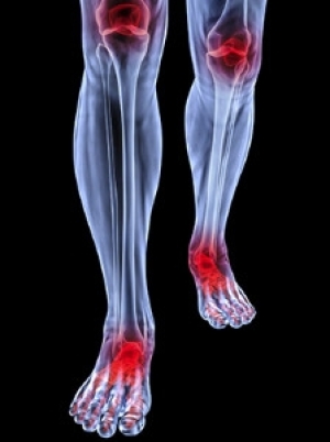 What is Rheumatoid Arthritis?