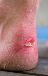 How to avoid blisters on the feet