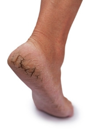 Relieving Cracked Heels