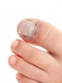 Does My Child Have a Broken Toe?