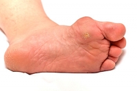 What Are The Treatment Options for Bunions?